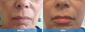 belotero fillers before and after