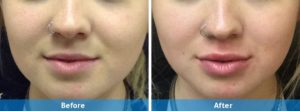 Juvederm before and after