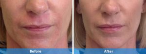 lip fillers before and after