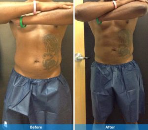 Before and after SculpSure