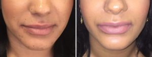 lip fillers before and after