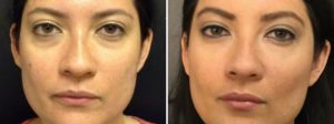 dermal fillers before and after