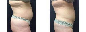 laserlipo before and after