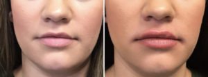 lip fillers before and after
