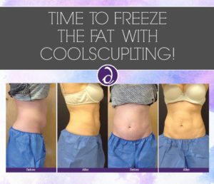 san diego coolsculpting event