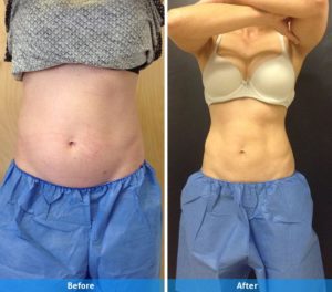 coolsculpting before and after