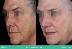 Enlighten SR Before and After