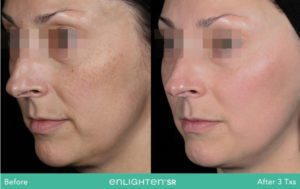 Enlighten SR Before and After