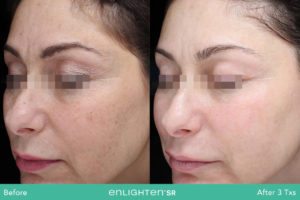 Enlighten SR Before and After