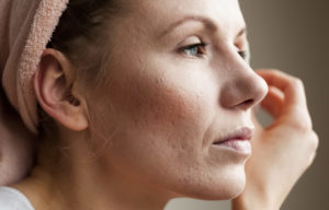 acne scarring patient