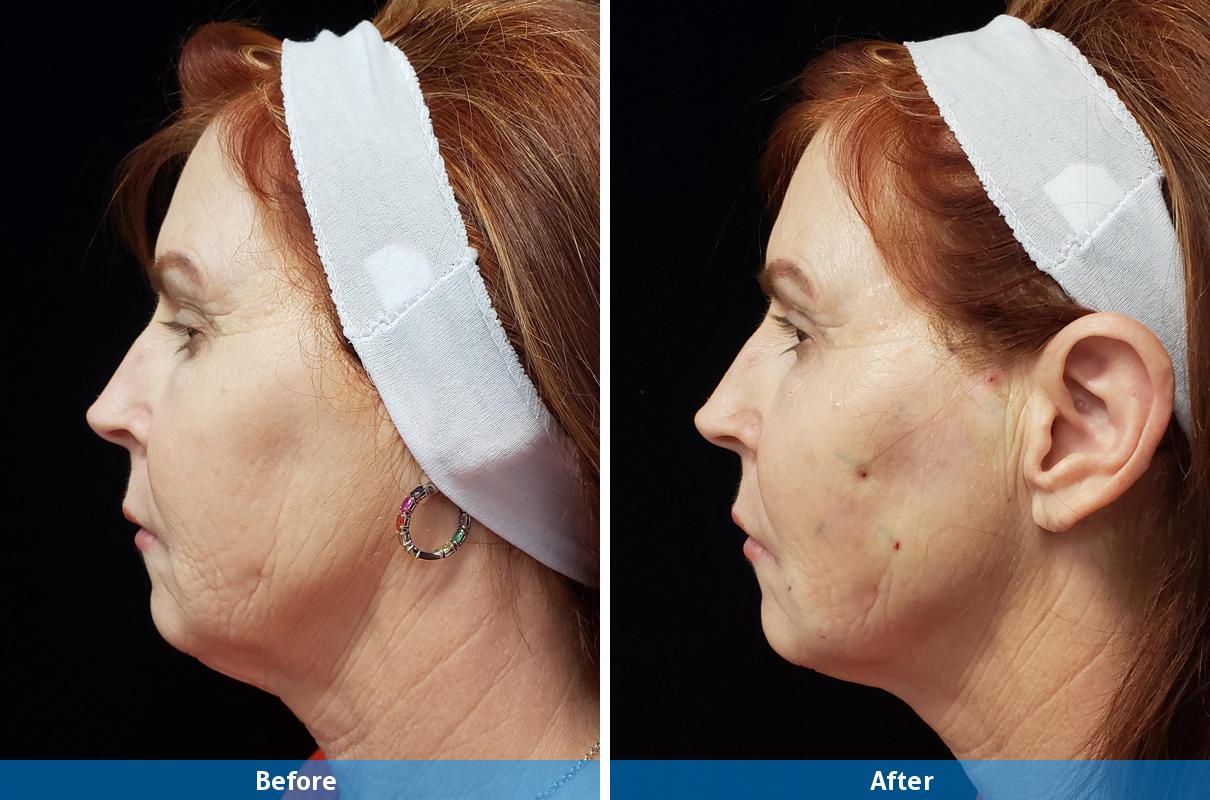 thread lift patient