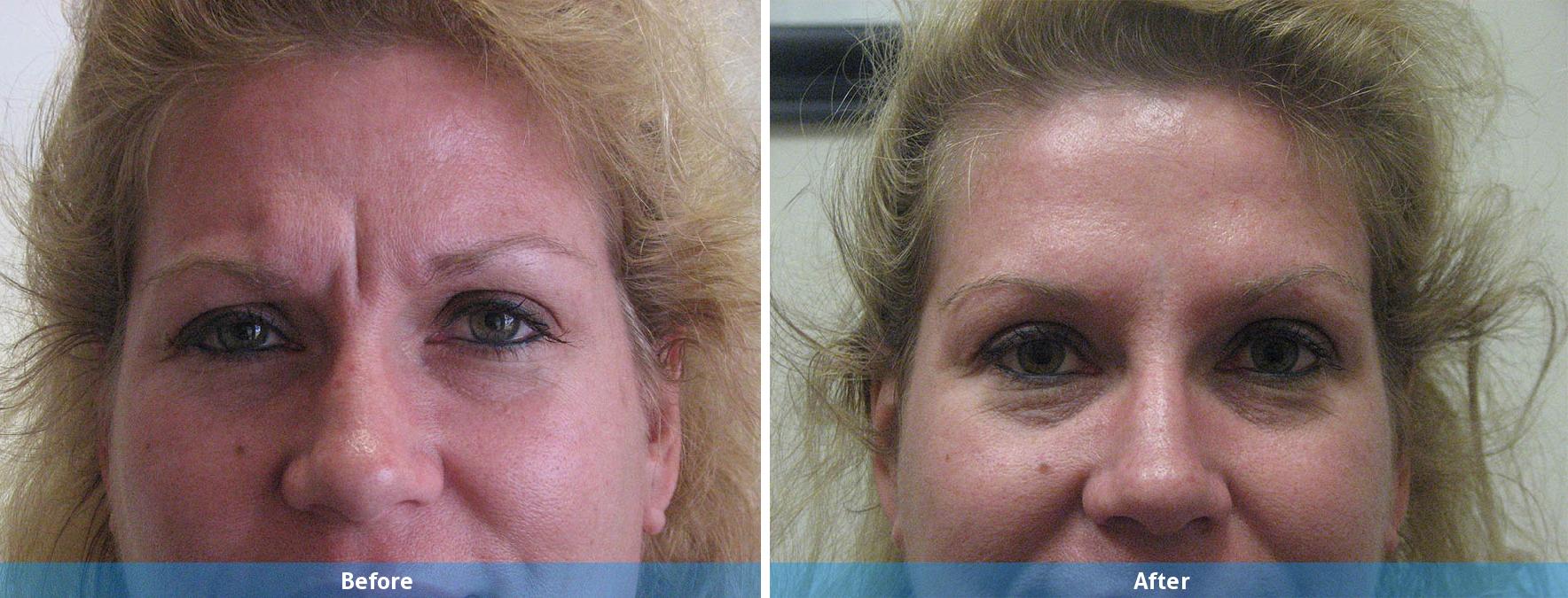 female botox before and after