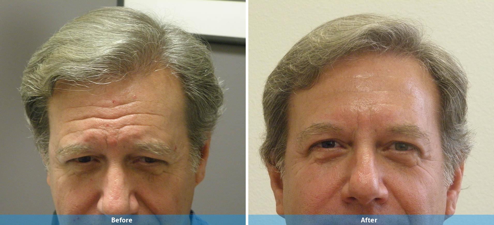 male before after botox