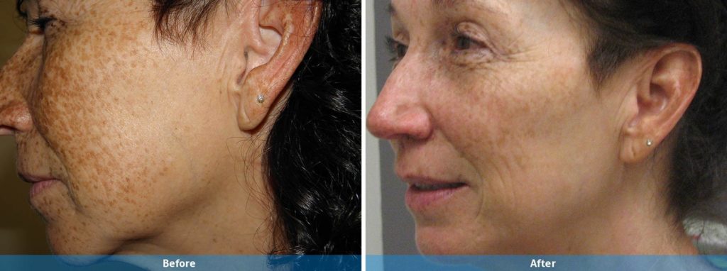 IPL before and after