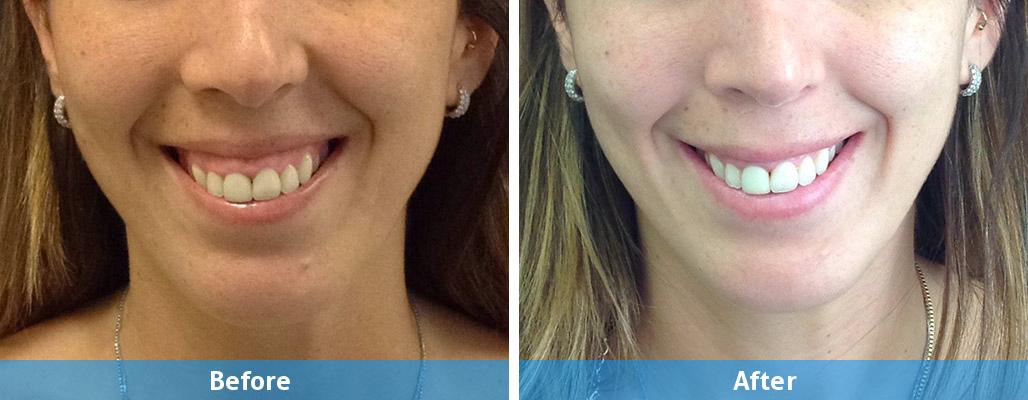 female botox before after