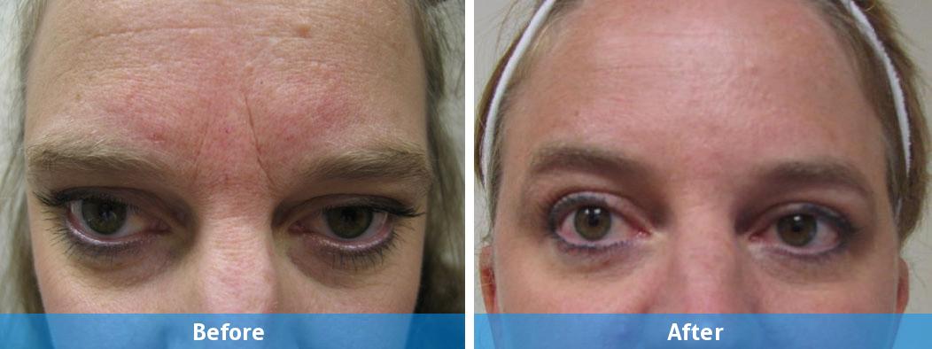 botox before after female