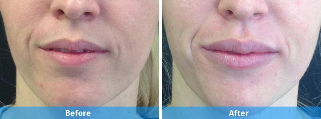 juvederm before and after