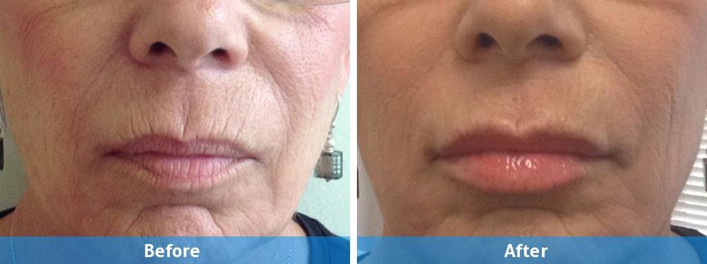 belotero fillers before and after