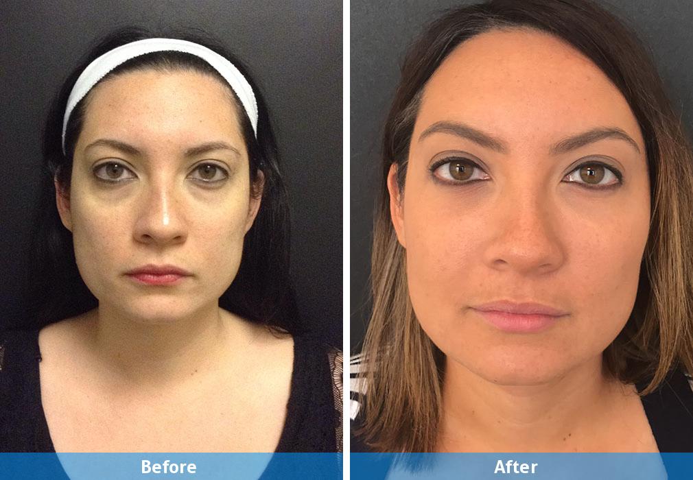 chemical peel before and after