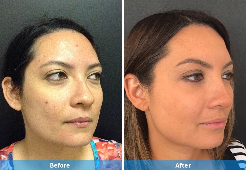 chemical peel before and after