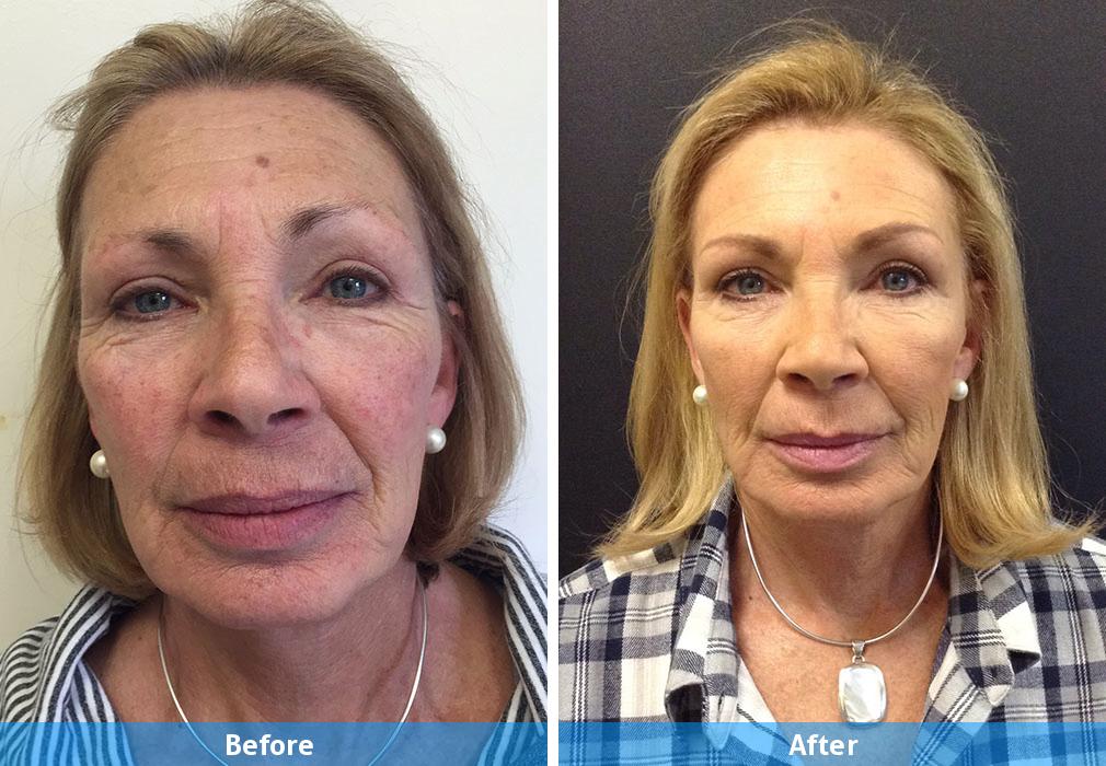 sculptra before after