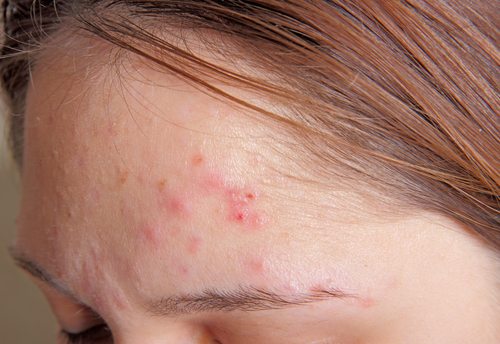 acne vulgaris