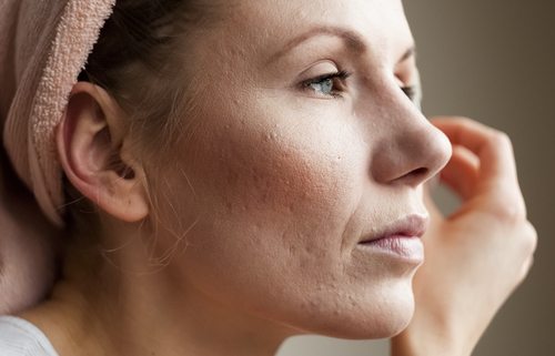 acne treatment la jolla