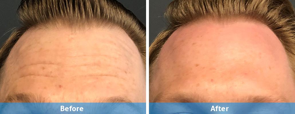 male botox before after