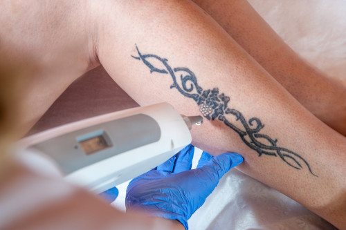 tattoo removal southern california