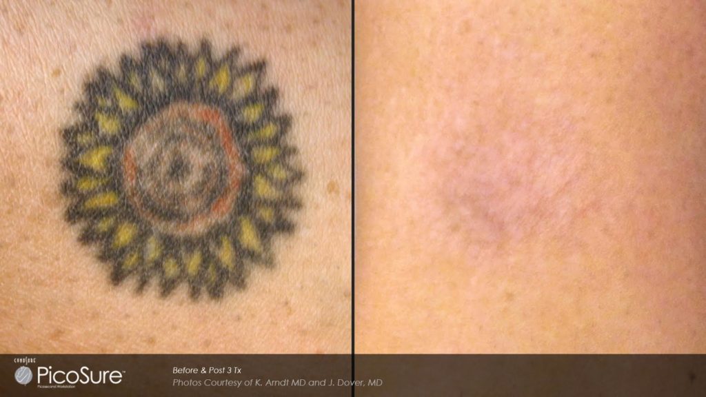 tattoo removal san diego