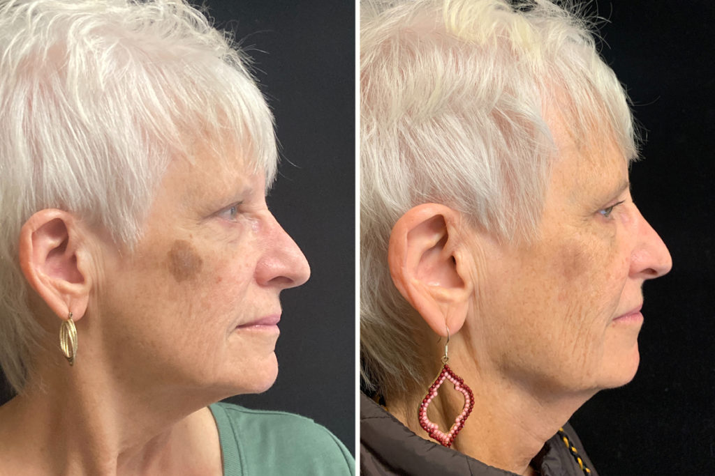 picosure before after