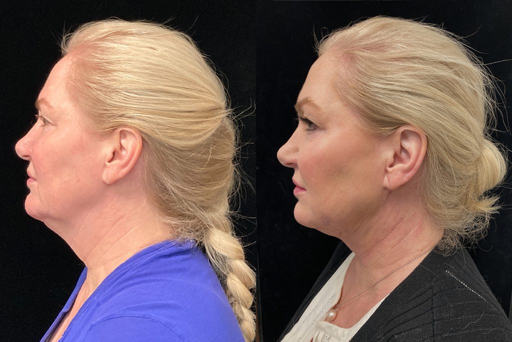 myellevate before after