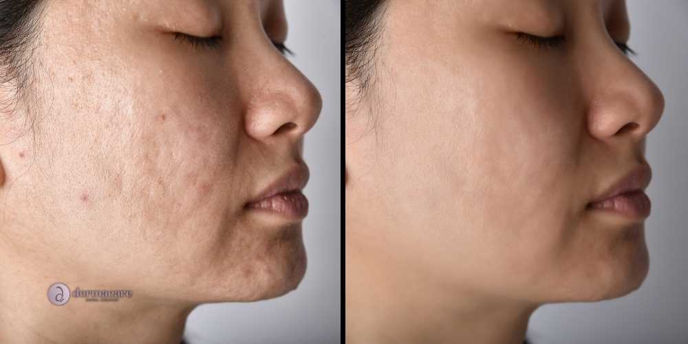 Chemical Peels San Diego