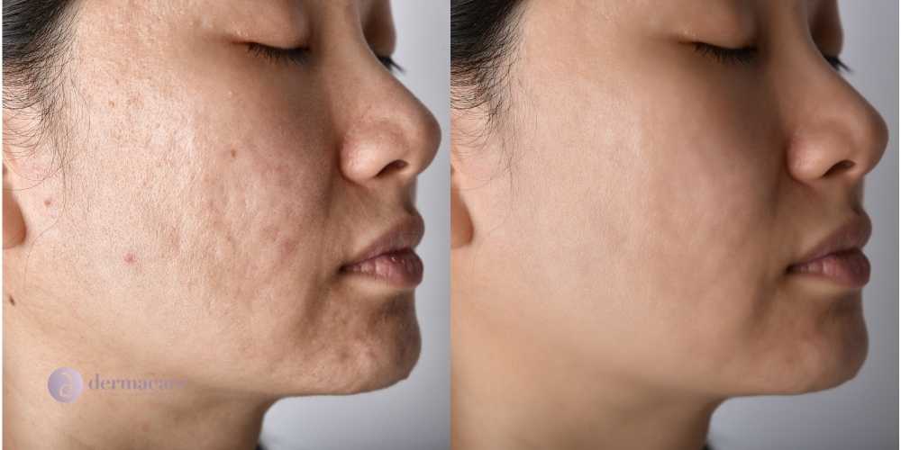 acne facial san diego