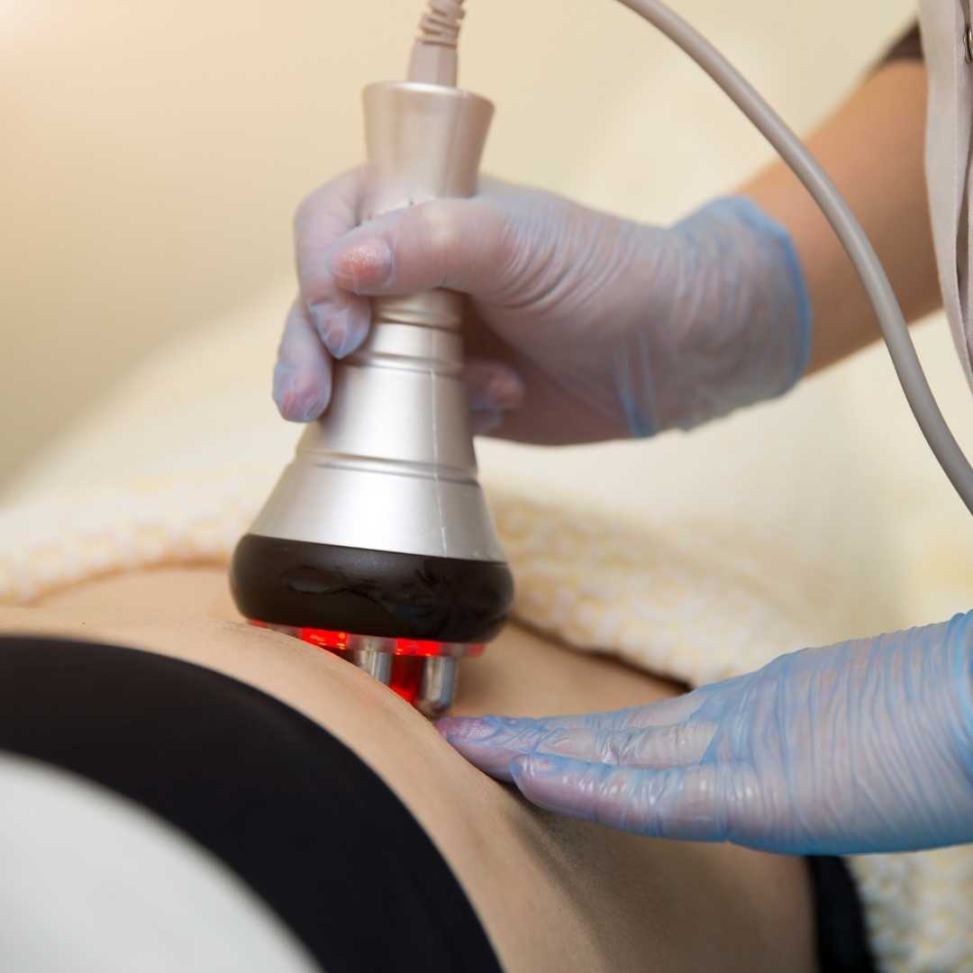 laser stretch mark removal san diego